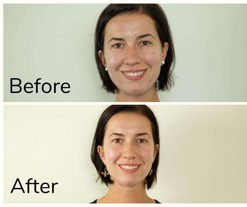 Before and After a Peel: What to Photos